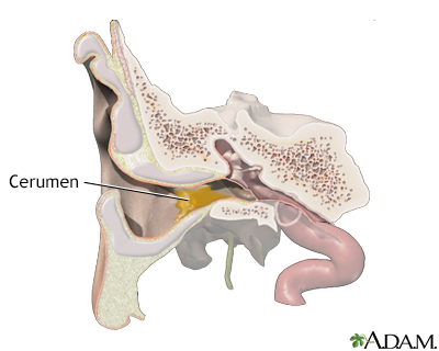 Wax blockage in the ear Wax blockage in the ear