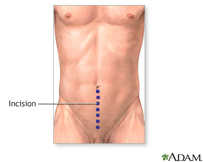 Incision Incision