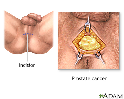 Incision Incision