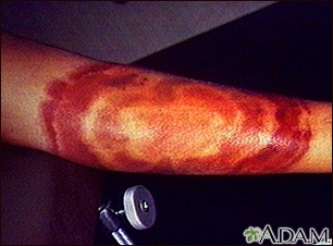 Lyme disease, erythema chronicum migrans Lyme disease, erythema chronicum migrans