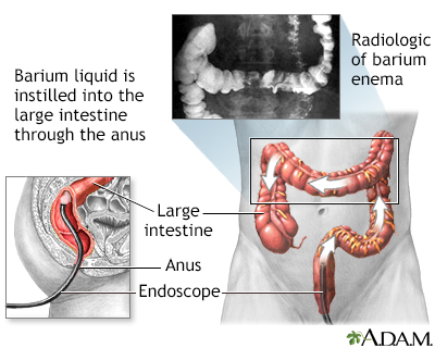 Barium enema Barium enema