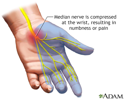 Carpal tunnel syndrome Carpal tunnel syndrome