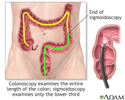 Colonoscopy Colonoscopy