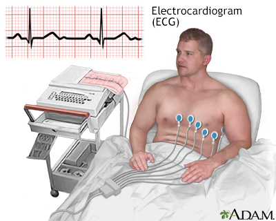 ECG ECG