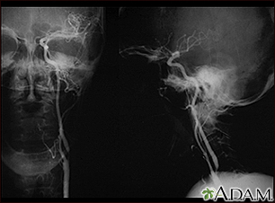 Carotid stenosis, X-ray of the left artery Carotid stenosis, X-ray of the left artery