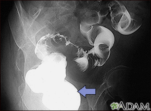 Sigmoid colon cancer, X-ray Sigmoid colon cancer, X-ray