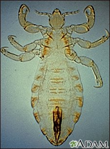Body louse Body louse