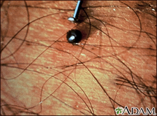 Tick, deer engorged on the skin Tick, deer engorged on the skin