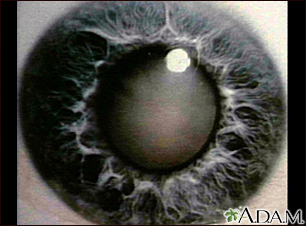 Cataract - close-up of the eye Cataract - close-up of the eye
