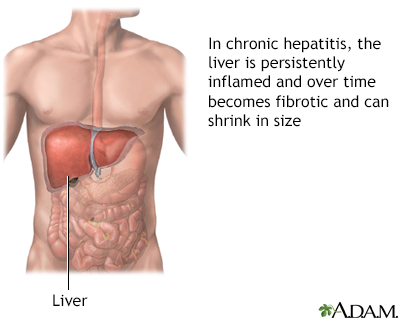 Aggressive hepatitis Aggressive hepatitis