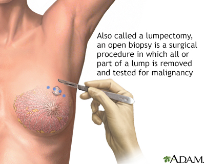 Open biopsy of the breast Open biopsy of the breast