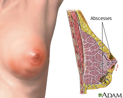 Breast infection Breast infection