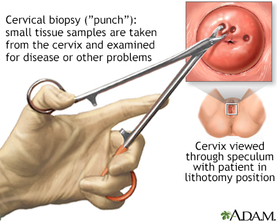 Cervical biopsy Cervical biopsy