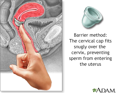 The cervical cap The cervical cap