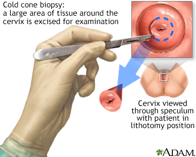 Cold cone biopsy Cold cone biopsy