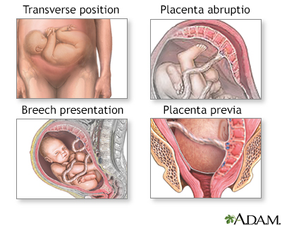 Cesarean section Cesarean section