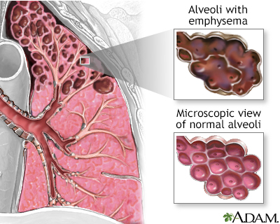 Emphysema Emphysema
