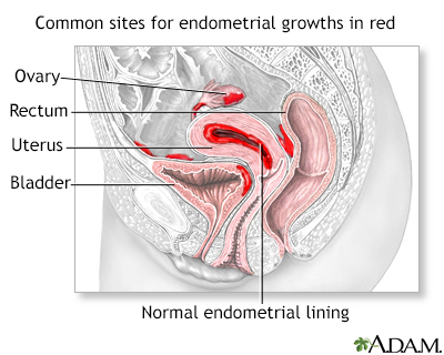 Endometriosis Endometriosis
