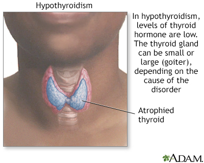Hypothyroidism Hypothyroidism