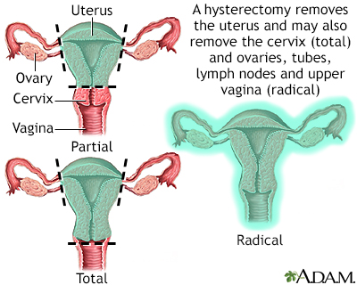 Hysterectomy Hysterectomy