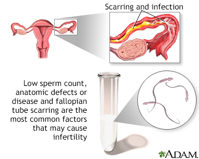 Infertility Factors Infertility Factors