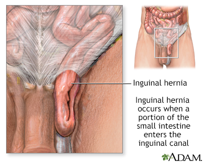 Inguinal hernia Inguinal hernia