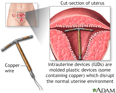 Intrauterine device Intrauterine device