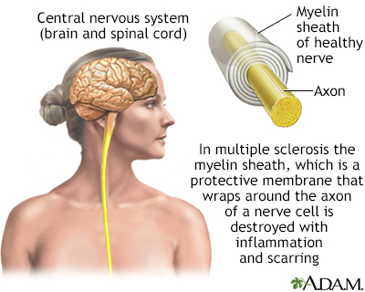 Multiple sclerosis Multiple sclerosis