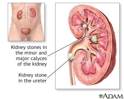 Nephrolithiasis Nephrolithiasis
