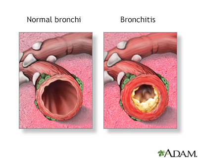 Bronchitis Bronchitis