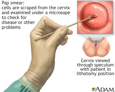 Pap smear Pap smear