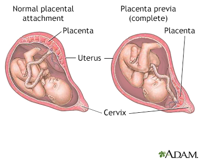 Placenta Previa Placenta Previa