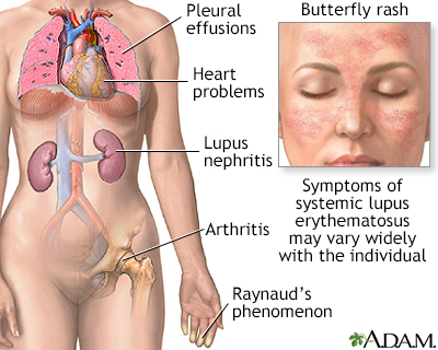 Systemic lupus erythematosus Systemic lupus erythematosus