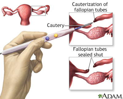 Tubal ligation Tubal ligation