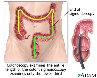 Tests for colon cancer Tests for colon cancer
