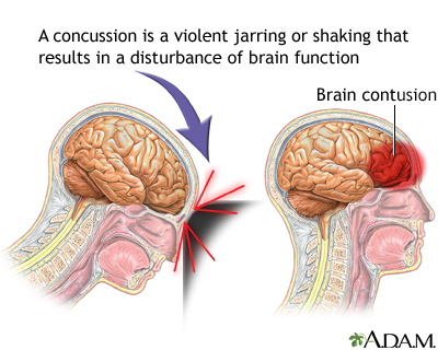 Concussion Concussion