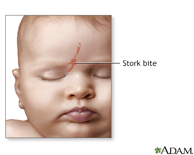 Stork bite Stork bite