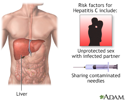 Hepatitis C Hepatitis C
