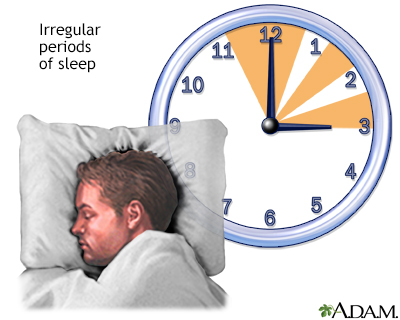 Irregular sleep Irregular sleep