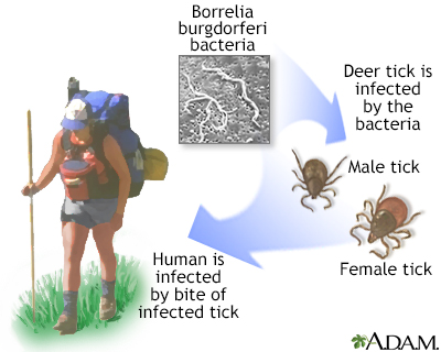 Lyme disease Lyme disease