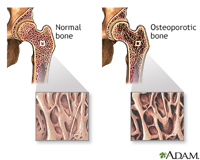 Osteoporosis Osteoporosis