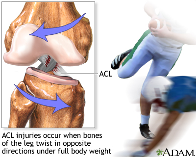 ACL injury ACL injury