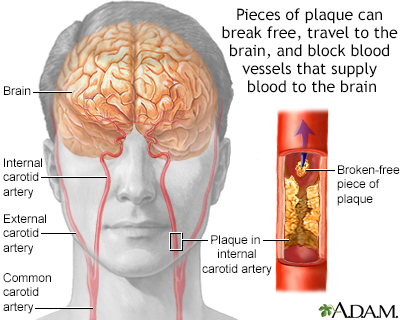 Atherosclerosis of internal carotid artery Atherosclerosis of internal carotid artery