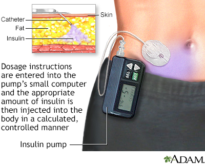 Insulin pump Insulin pump