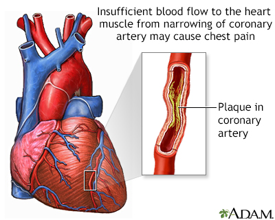 Angina Angina