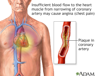 Stable angina Stable angina
