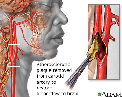 Endarterectomy Endarterectomy