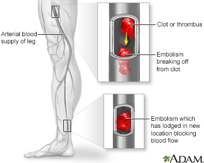 Arterial embolism Arterial embolism