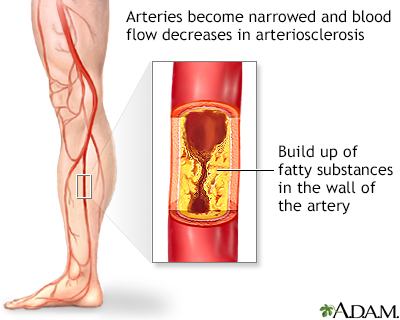Arteriosclerosis of the extremities Arteriosclerosis of the extremities
