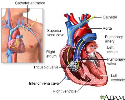 Swan Ganz catheterization Swan Ganz catheterization